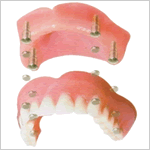 上顎総義歯例