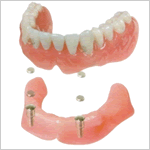 下顎総義歯例